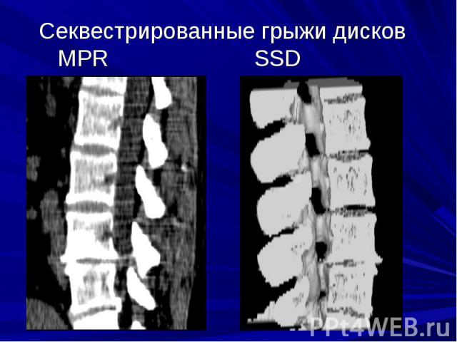 Секвестрированные грыжи дисков MPR SSD