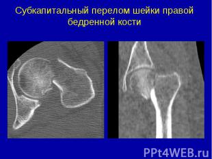 Субкапитальный перелом шейки правой бедренной кости