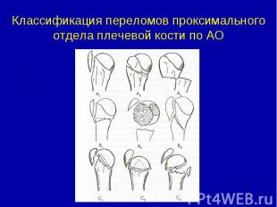 Классификация переломов проксимального отдела плечевой кости по АО