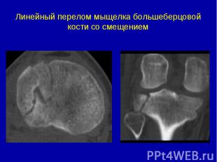 Линейный перелом мыщелка большеберцовой кости со смещением