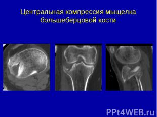 Центральная компрессия мыщелка большеберцовой кости