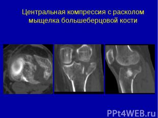 Центральная компрессия с расколом мыщелка большеберцовой кости