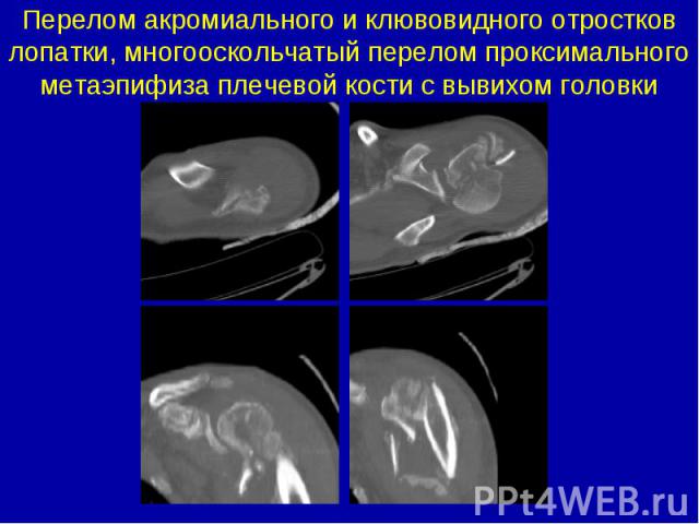 Перелом акромиального и клювовидного отростков лопатки, многооскольчатый перелом проксимального метаэпифиза плечевой кости с вывихом головки