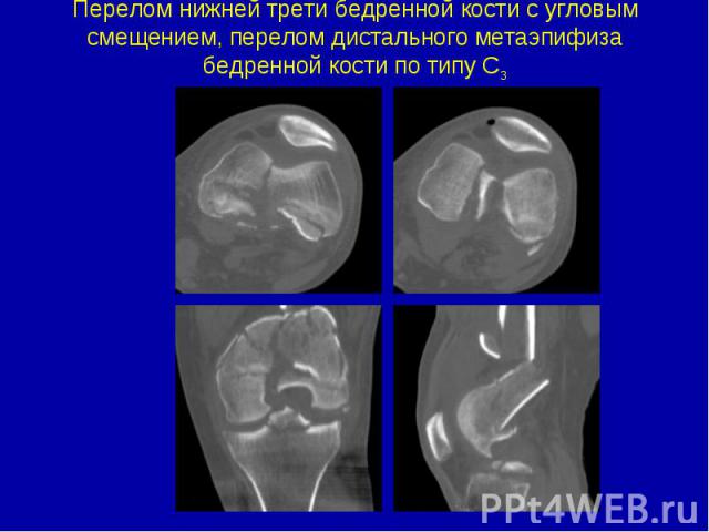 Перелом нижней трети бедренной кости с угловым смещением, перелом дистального метаэпифиза бедренной кости по типу С3
