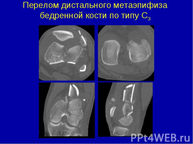 Перелом дистального метаэпифиза бедренной кости по типу С3