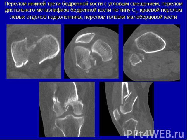 Перелом нижней трети бедренной кости с угловым смещением, перелом дистального метаэпифиза бедренной кости по типу С3, краевой перелом левых отделов надколенника, перелом головки малоберцовой кости