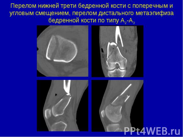Перелом нижней трети бедренной кости с поперечным и угловым смещением, перелом дистального метаэпифиза бедренной кости по типу А2-А3