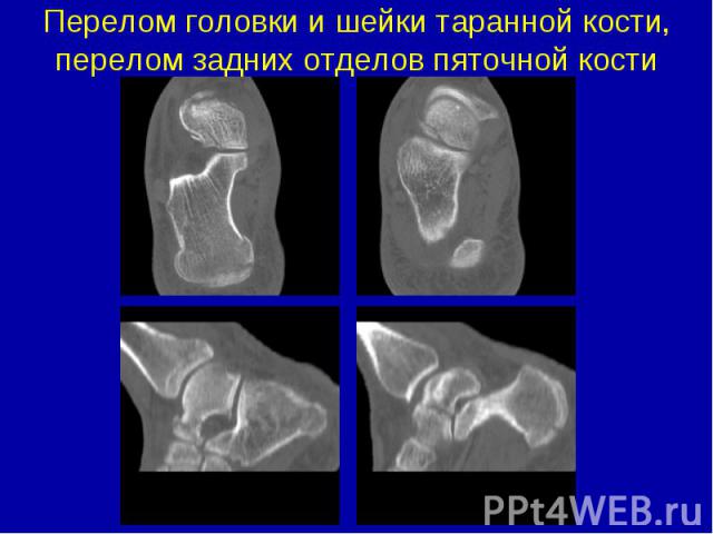 Перелом головки и шейки таранной кости, перелом задних отделов пяточной кости