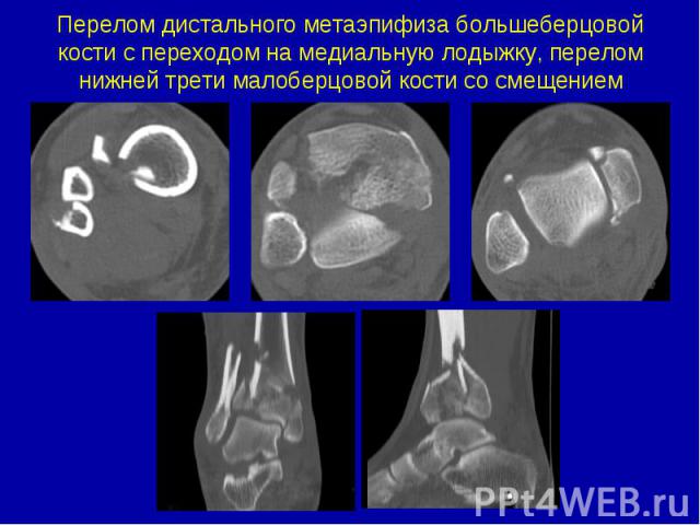 Перелом дистального метаэпифиза большеберцовой кости с переходом на медиальную лодыжку, перелом нижней трети малоберцовой кости со смещением