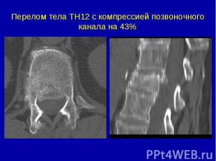 Перелом тела ТН12 с компрессией позвоночного канала на 43%