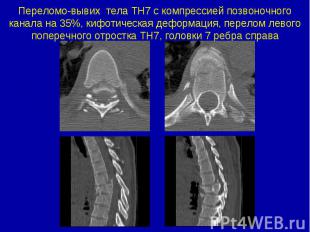 Переломо-вывих тела ТН7 с компрессией позвоночного канала на 35%, кифотическая д