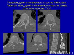 Перелом дужки и поперечного отростка ТН8 слева. Перелом тела, дужки и поперечног