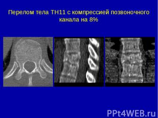 Перелом тела ТН11 с компрессией позвоночного канала на 8%