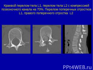Краевой перелом тела L1, перелом тела L2 с компрессией позвоночного канала на 70