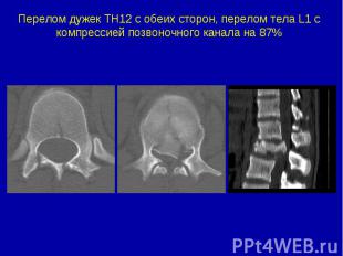 Перелом дужек ТН12 с обеих сторон, перелом тела L1 c компрессией позвоночного ка