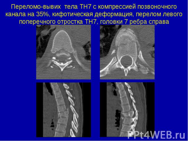 Переломо-вывих тела ТН7 с компрессией позвоночного канала на 35%, кифотическая деформация, перелом левого поперечного отростка ТН7, головки 7 ребра справа
