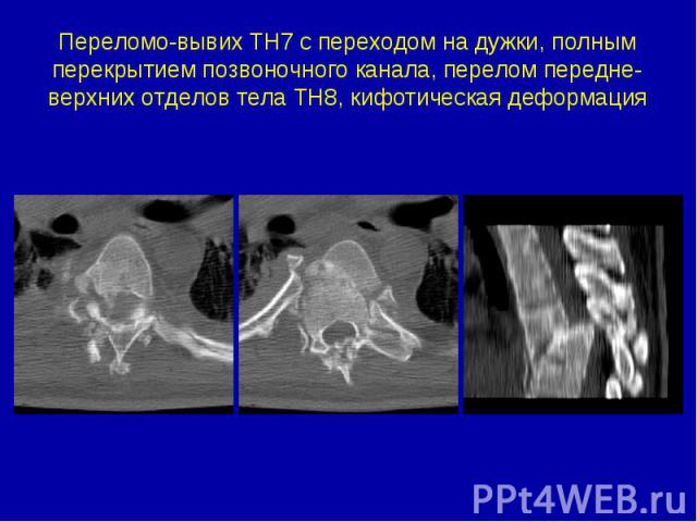 Переломо-вывих ТН7 с переходом на дужки, полным перекрытием позвоночного канала, перелом передне-верхних отделов тела ТН8, кифотическая деформация