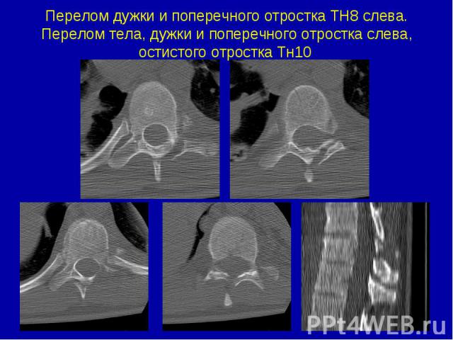 Перелом дужки и поперечного отростка ТН8 слева. Перелом тела, дужки и поперечного отростка слева, остистого отростка Тн10