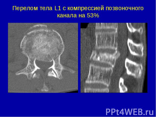Перелом тела L1 c компрессией позвоночного канала на 53%