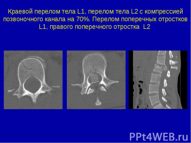 Краевой перелом тела L1, перелом тела L2 с компрессией позвоночного канала на 70%. Перелом поперечных отростков L1, правого поперечного отростка L2
