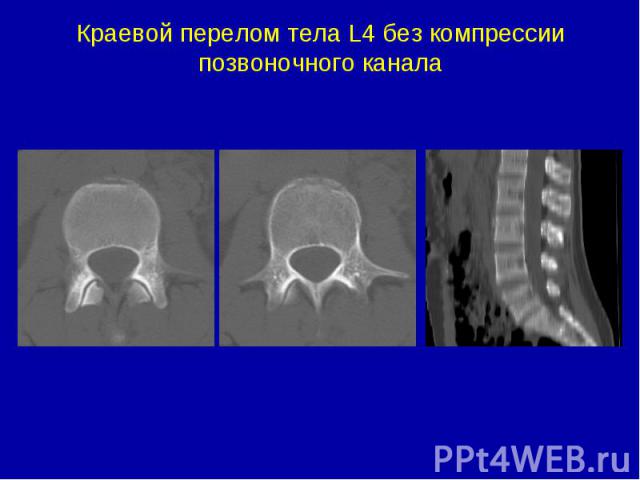 Краевой перелом тела L4 без компрессии позвоночного канала