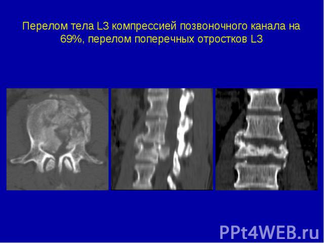 Перелом тела L3 компрессией позвоночного канала на 69%, перелом поперечных отростков L3