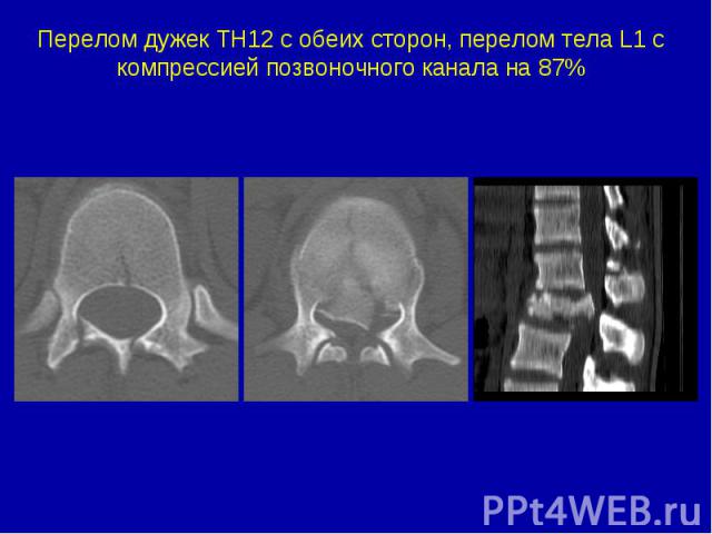 Перелом дужек ТН12 с обеих сторон, перелом тела L1 c компрессией позвоночного канала на 87%