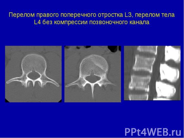 Перелом правого поперечного отростка L3, перелом тела L4 без компрессии позвоночного канала