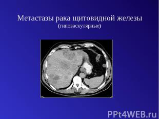 Метастазы рака щитовидной железы (гиповаскулярные)