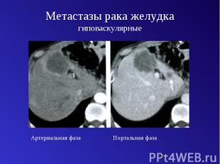 Метастазы рака желудка гиповаскулярные
