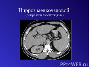 Цирроз мелкоузловой (гиперплазия хвостатой доли)