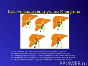 Классификация опухоли Клацкина