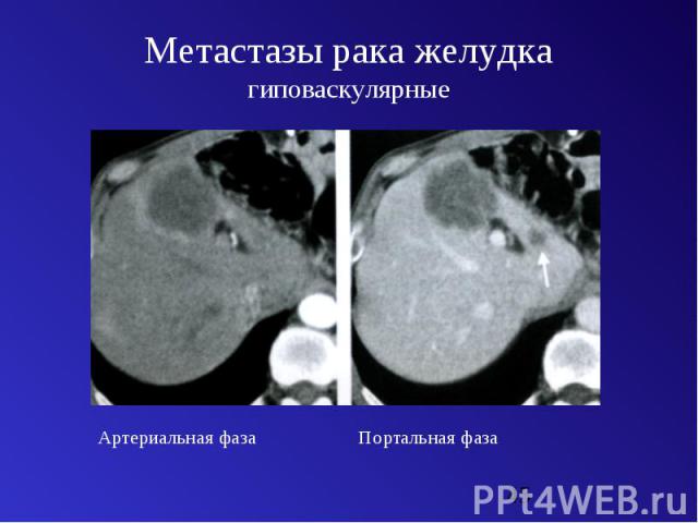Метастазы рака желудка гиповаскулярные