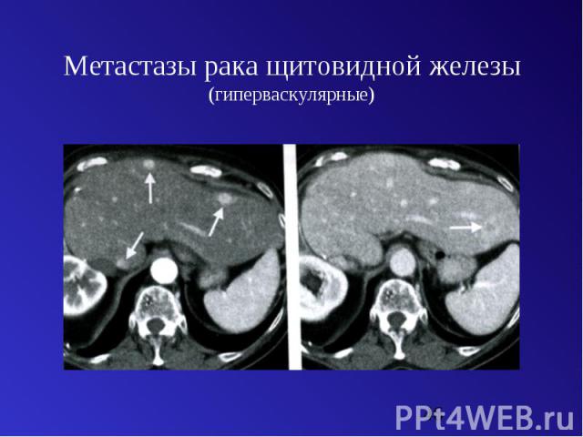 Метастазы рака щитовидной железы (гиперваскулярные)