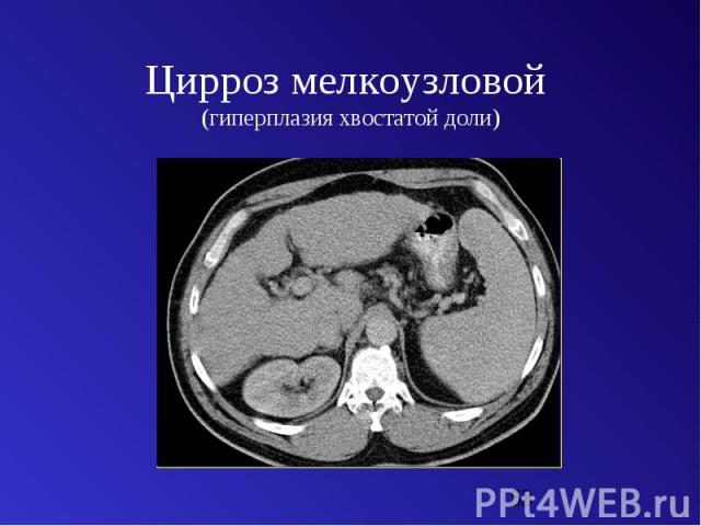 Цирроз мелкоузловой (гиперплазия хвостатой доли)