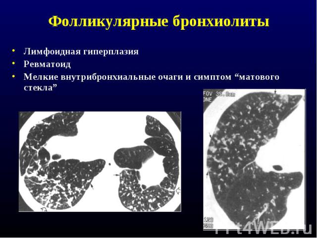 Фолликулярные бронхиолиты Лимфоидная гиперплазия Ревматоид Мелкие внутрибронхиальные очаги и симптом “матового стекла”