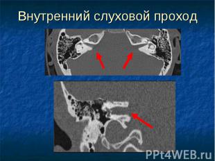 Внутренний слуховой проход