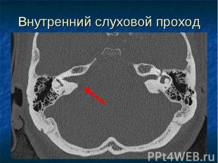 Внутренний слуховой проход