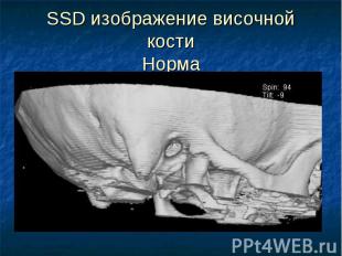 SSD изображение височной кости Норма