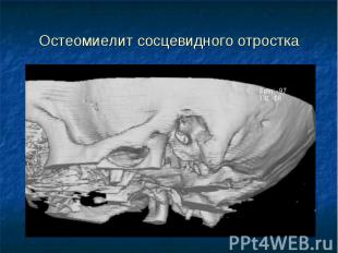 Остеомиелит сосцевидного отростка