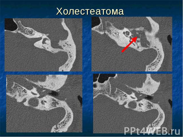 Холестеатома