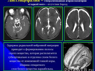 Лиссэнцефалия – генерализованная агирия-пахигирия «гладкий мозг» - отсутствие бо