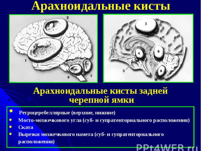 Арахноидальные кисты Ретроцеребеллярные (верхние, нижние) Мосто-мозжечкового угла (суб- и супратенториального расположения) Ската Вырезки мозжечкового намета (суб- и супратенториального расположения)