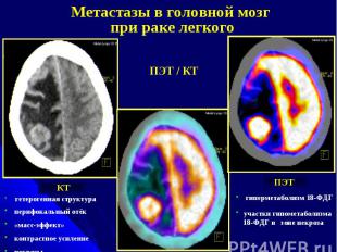 Метастазы в головной мозг при раке легкого