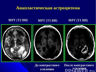 Анапластическая астроцитома