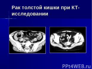 Рак толстой кишки при КТ-исследовании