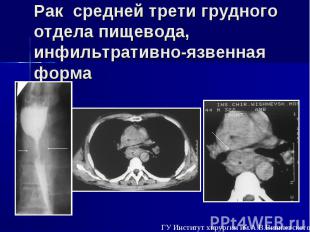 Рак средней трети грудного отдела пищевода, инфильтративно-язвенная форма