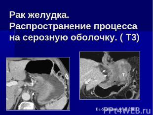 Рак желудка. Распространение процесса на серозную оболочку. ( Т3)