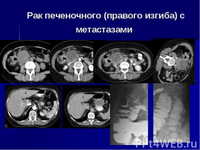 Рак печеночного (правого изгиба) с метастазами