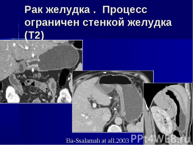 Рак желудка . Процесс ограничен стенкой желудка (Т2)